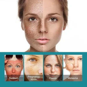 Eelhoe - Dark Spots Removes Cream (Original)